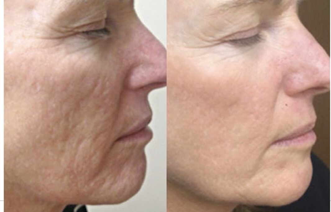 Face PRP Treatment