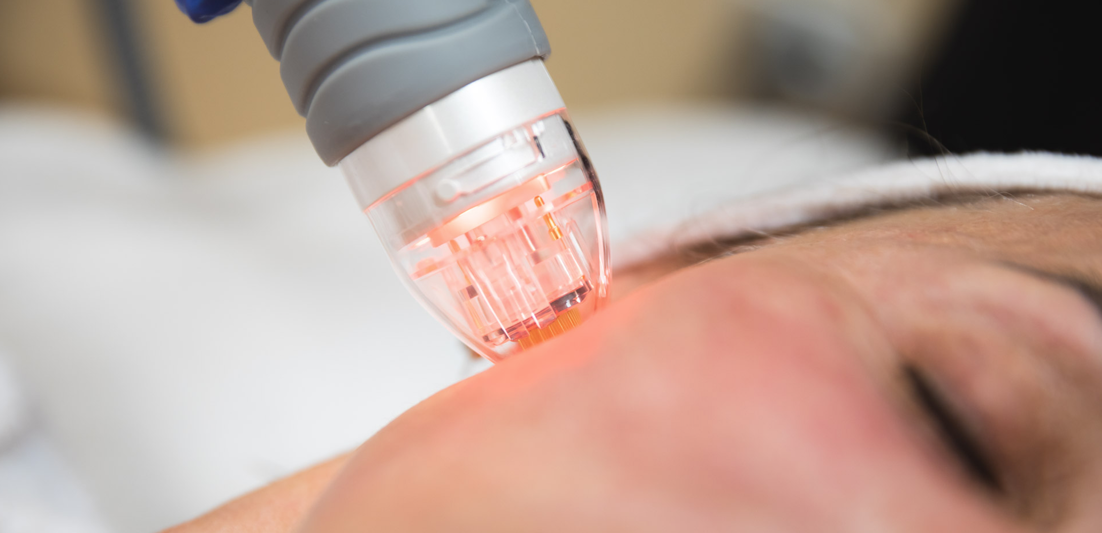 RF microneedling