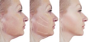 What is Thermage Procedure and How Can It Help in Skin Rejuvenation?